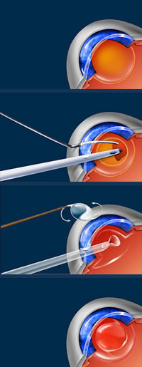 Cataract Surgery